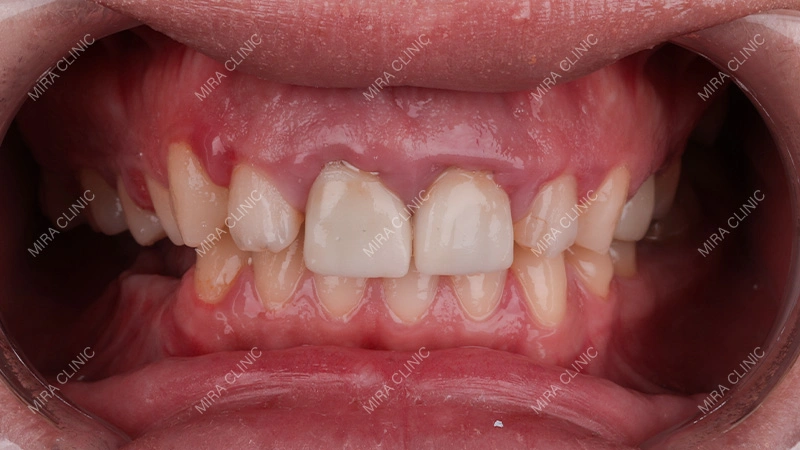 gum-related issues
